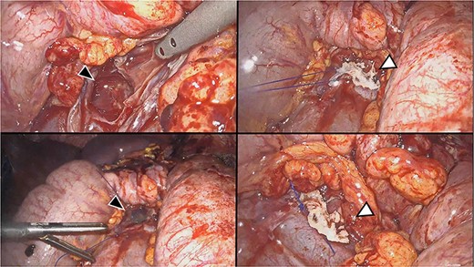 Sequential phases of identification and closure of the leakage. Identification by methylene blue outflow (top black arrow head). Suture with non-absorbable stitch (bottom black arrow head). Cyanoacrylate positioning and final result (respectively, from top to bottom white arrowheads).
