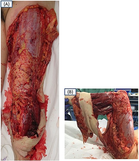 Frontal (A) and oblique (B) views of the left extremity on admission. The anterior and lateral skin and subcutis of the left extremity are avulsed over the fascia and degloved from the inguinal region to the left ankle joint area.