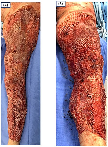 Lateral (A) and medial oblique views (B) of the left extremity at grafting. Meshed STSG harvested from the avulsed flap is attached.