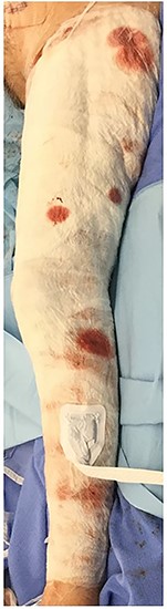 An oblique view of the left extremity with wound dressing in place. The meshed skin graft is secured by NPWT set over the wound dressing.
