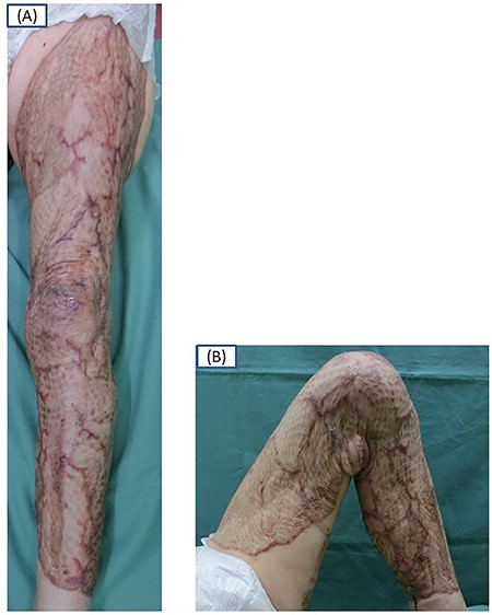 Skin graft take confirmed 2 months after surgery. A frontal view shows the extended knee at 0° (A) and a medial view shows the flexed knee at 130° (B).