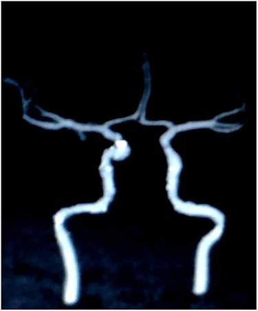 Digital subtraction carotid angiography showing small hyperdense area in the right cavernous carotid artery.