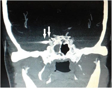 CT scan coronal view showing gun pellets near the right cavernous carotid artery (arrows).