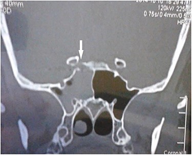 CT scan coronal view showing right sphenoid sinus opacification with denudation of sphenoid sinus wall (arrow).