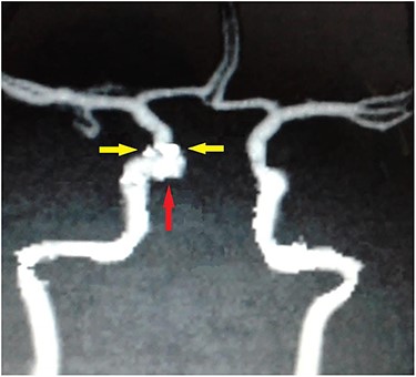 Carotid angiography showing small gun pellets (yellow arrows) and pseudoaneurysm (red arrow) of the right CCA.