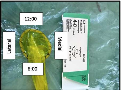 Orientation of external stoma diversion: the image shows a model of the external stoma diversion and its orientation, with the most cephalad point at 12:00 and most caudad point at 6:00.