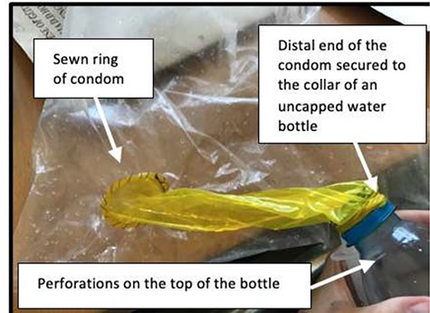 External stoma diversion prototype: this image shows a prototype, in which the condom ring is sewn around the stoma (here represented by a plastic bag) and the distal end divided 1 cm proximal to the reservoir and secured to the uncapped collar of a plastic water bottle using a rubber band.