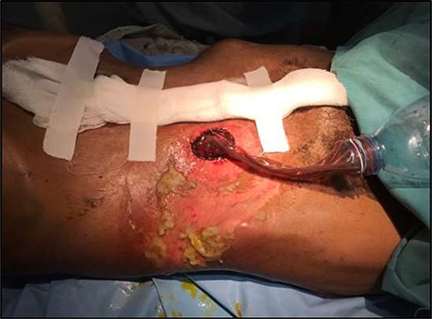 External stoma diversion; this image shows the external stoma diversion as applied in the patient setting.