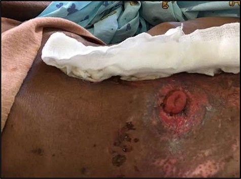 Improved peristomal wound; on postoperative day 7 the external stoma diversion was removed; significant improvement of peristomal skin maceration is noted.