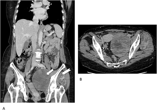 Multidetector computed tomography appearance of the lesions. Coronal multiplanar reformation (A) of the portal venous phase scan shows two different left-sided solid hypoattenuating masses located in the pelvis (arrow) and intermuscular space between the gluteus medius muscle and gluteus minimus muscle (arrowhaed). Progressive, slow and inhomogeneous contrast-enhancement occurred (B), as better appreciated in the transverse image acquired in the delayed phase.