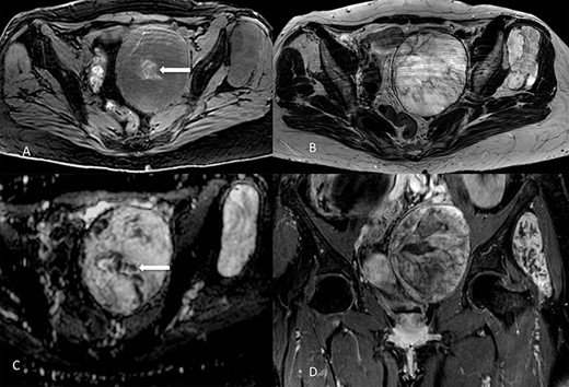 Lesions appearance on MR imaging. On transverse fat-saturated volumetric gradient echo T1-weighted imaging (A) both masses appeared slightly hypointense compared to muscle, with hyperintense areas in the larger one (arrow) suggesting the presence of haemorrhagic foci. Lesions were hyperintense on transverse turbo spin-echo T2-weighted imaging (B), in line with the presence of myxoid content, showing inhomogeneous appearance due to low-signal septa showing restricted diffusion on the apparent diffusion coefficient map (arrow in C). Contrast enhancement was inhomogeneous, as shown in the coronal fat-saturated post-contrast image (D). Masses showed well-defined margins, with no invasion of the adjacent structures.