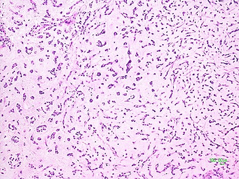 Histological picture of the tumor showing clusters and chords of medium-sized epithelioid cells immersed in a myxoid matrix (H&E, ×100).