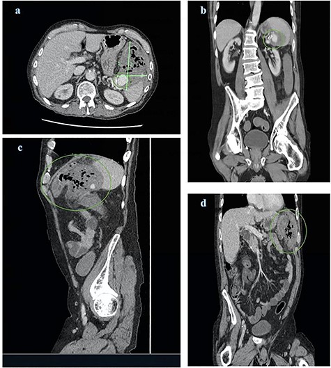 CT abdomen and pelvis views of the known splenic artery pseudoaneurysm with intravenous contrast (a) and (b) surrounded by a large inflammatory mass (a), (c) and (d); the mass demonstrates multiple foci of air and is intimately related to the splenic flexure