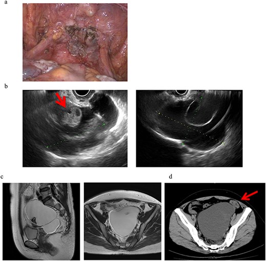 Clinical findings of case 1. (a) Findings at the end of TLH. No abnormal findings were detected. (b) An US image of PIC in case 1. An ovary with a normal appearance was observed within the multilocular cyst. (c) T2-weighted MRI image. (d) CT findings with abdominal pain. A giant cyst appears to compress the sigmoid colon, resulting in abdominal pain and the impaired passage of the stool mass.