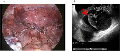 Clinical findings of case 2 (before surgery for PIC). (a) Findings at the end of TLH. No abnormal findings were detected. (b) An US image of PIC. The major axis was 95 mm. An ovary with a normal appearance was observed within the multilocular cyst.