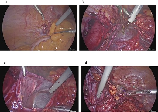 Clinical findings of case 2 (during surgery for PIC). (a) Strong adhesion between the sigmoid colon and pelvic wall in the left adnexal region. (b) When the sigmoid mesentery and left pelvic peritoneum were removed and the cyst was opened, a yellow transparent liquid was ejected. (c) The cavity formed by adhesions. (d) Left ovarian tissue inside PIC.