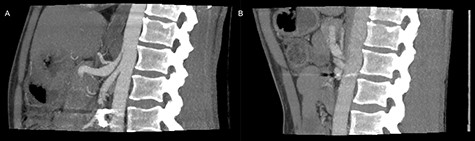 Preoperative inspiratory (A) and expiratory (B) computed tomography scan, visualizing hook formation and stenosis of the celiac artery.