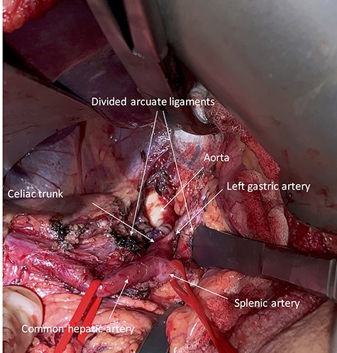 Intraoperative photography showing the exposed celiac trunk and divided arcuate ligaments.