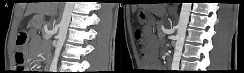 Postoperative inspiratory (A) and expiratory (B) computed tomography scan with repealed hook formation as well as stenosis of the celiac artery.