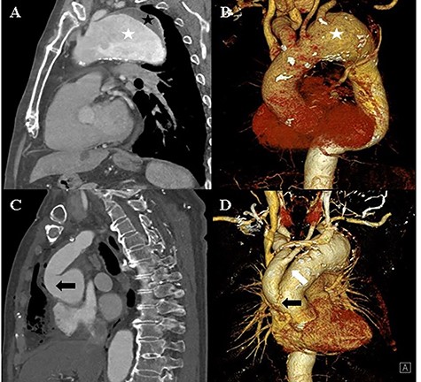 A and B: Computed tomography of the chest shows an aortic aneurysm (white asterisk) with a mural thrombus (black asterisk) at the distal arch. C and D: Post-debranching operative computed tomography of the chest shows the graft, which is directly sutured onto the ascending aorta (black arrow), and the graft used from the innominate artery to the left common carotid artery (white arrow).