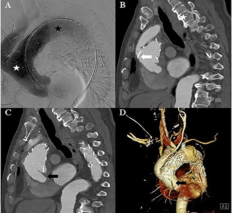 A: Aortic angiography during TEVAR shows the thoracic graft implanted in the ascending thoracic aorta and aortic arch (white asterisk) and the thoracic graft implanted in the aortic arch and descending thoracic aorta (black asterisk). B: Computed tomography of the post-TEVAR shows the placed thoracic graft (white arrow). C and D: Computed tomography of the post-TEVAR shows the intimal dissecting flap at the proximal ascending aorta.