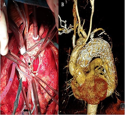 A: Intraoperative view of the transected ascending aorta due to the thoracic stent graft (black asterisk). B: The post-operation computed tomography image shows the replaced ascending aorta (white asterisk).