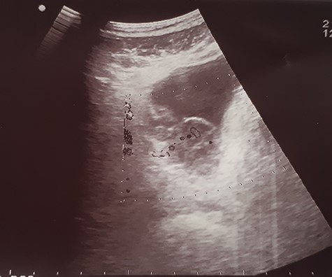 Ultrasound image showing an irregular wall thickening in the right lateral face and the floor of the bladder.
