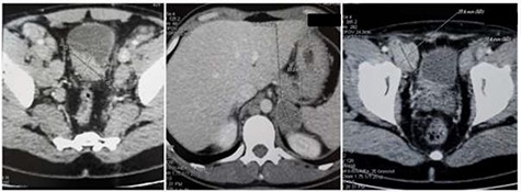 Abdominal CT scan: (a) wall thickening of the bladder, (b) 4 cm mass in the left adrenal gland and (c) 3 cm metastatic inguinal lymph node.