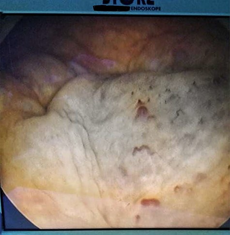 Cystoscopy showing a solid non-papillary black pigmented lesion of the bladder.