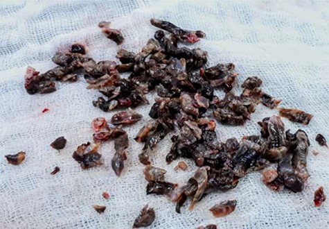 Pigmented tumor shavings.