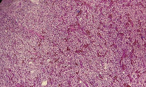 Hematoxylin and eosin staining × 10: diffuse tumor proliferation.