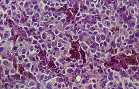 ×40: large polyhedral tumor cells, with melanic pigment and enlarged nuclei.