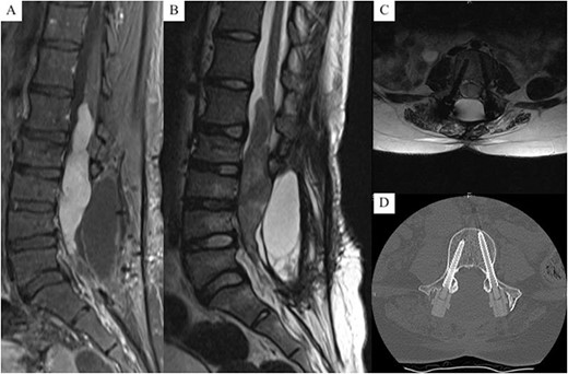 (A) T1 with contrast mid-sagittal MRI, (B) T2 mid-sagittal MRI, (C) T2 axial MRI at L4, (D) axial CT at L4 (bone window), demonstrating a L1 - L5 intradural tumour with significant cauda equina compression; no signal interference or artefacts from the screw construct are present, allowing clear visualisation of the vertebral body and canal.