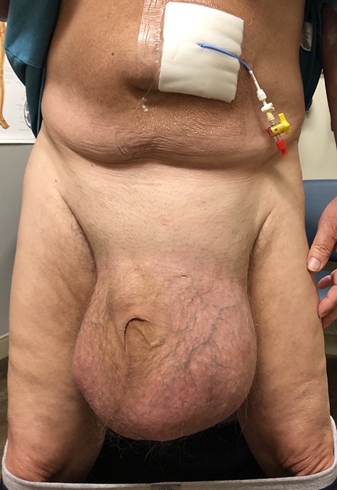 GIH extending past mid-thigh in upright position. Peritoneal port also shown above the umbilicus.