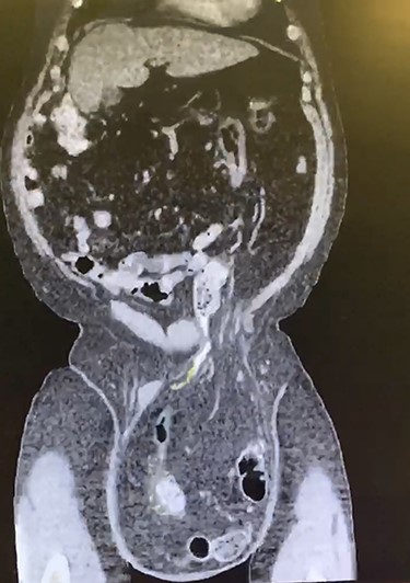 Coronal CT displaying sigmoid colon and accompanying abdominal contents traversing into the hernia sac.
