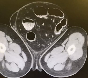 Transverse CT displaying colon within the hernia sac.