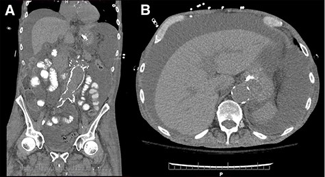 Coronal (A) and axial (B) sections of non-contrast enhanced abdominal computed tomography showing accumulation of large volume of peritoneal fluid. Aortic graft appears intact.