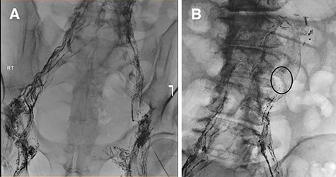 (A) Lymphangiogram and unsuccessful attempt at cannulating pelvic lymphatic channels. (B) Lymphatic leak is seen at the left of the L3-L4 level.