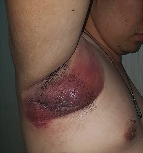 Right axillary mass.