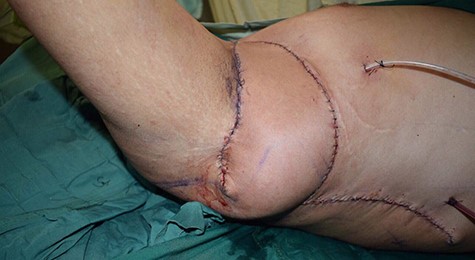 Parascapular fasciocutaneous flap.