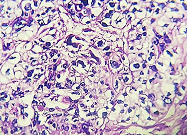 Section of the mass on hematoxylin and eosin stain at high power field magnification.
