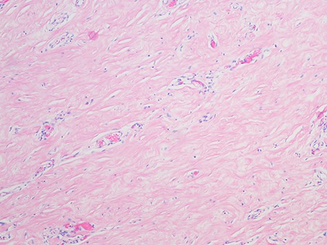 Pseudoangiomatous Stromal Hyperplasia; the slide shows collagenization of interlobular stroma, Myofibroblasts and abundant blood vessels (H&E, magnification x 100).