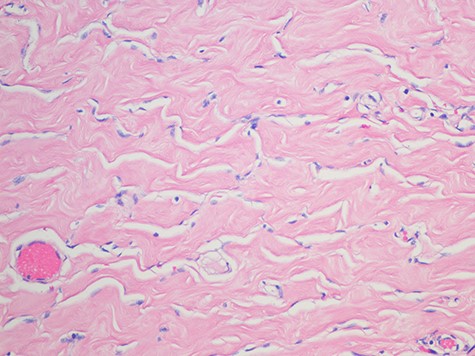 Pseudoangiomatous stromal hyperplasia; showing strands of collagen traverse some spaces and well-formed anastomosing spaces slits outlined by myofibroblasts with uniform, small flat nuclei (H&E magnification x 2).