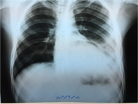 Chest X-ray.