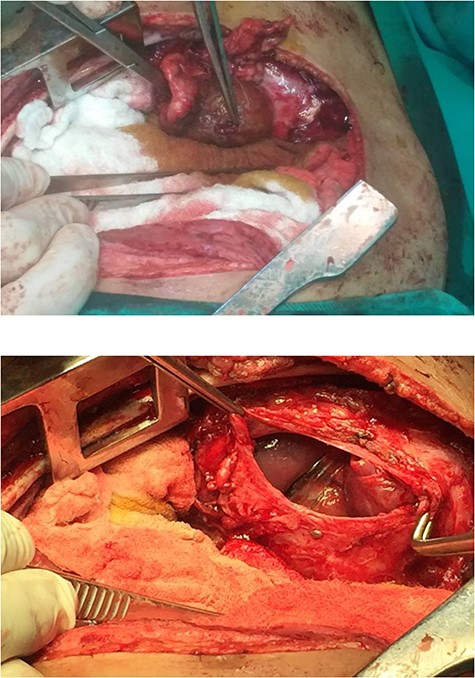 Surgical repair of the diaphragm.