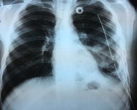 Chest X-ray 24 h after surgery.