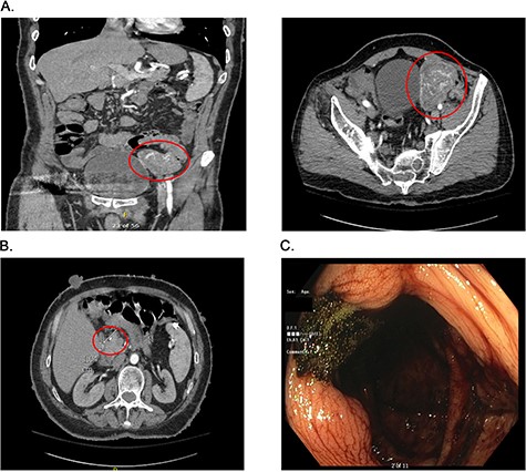 Presurgical diagnostics. (A) CT imaging of the large jejunal mass. (B) CT imaging of small duodenal mass. (C) Blood at the ileo-cecal valve.