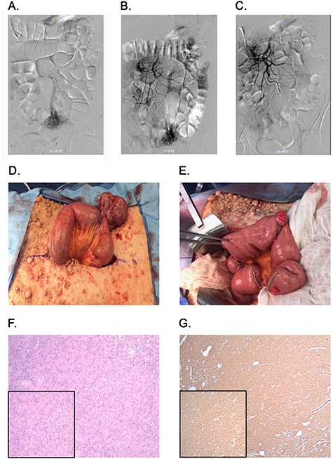Angiography, embolization and macroscopic and microscopic views of the tumors. (A) Angiography identifying blood flow to the mass. (B) Blood flow from ileal branches of the SMA to the jejunal mass. (C) Embolization of the blood supply to the jejunal mass. (D) Large jejunal mass. (E) Stretch of proximal jejunum with multiple masses. (F) H&E stained tumor slides; ×100 magnification with inset ×200 magnification. (G) DOG-1 stained tumor slides; ×40 magnification with inset ×100 magnification.