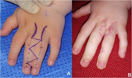 (A) Simple incomplete syndactyly demonstrating fusion of the middle and ring finger (B) Outcome following syndactyly release at 6 months post-operatively.