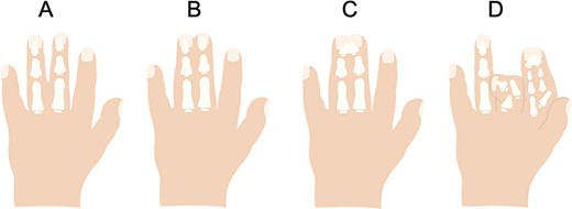 Diagrammatic representation of syndactyly subtypes (A) simple, incomplete (B) simple, complete (D) complex (D) complicated.